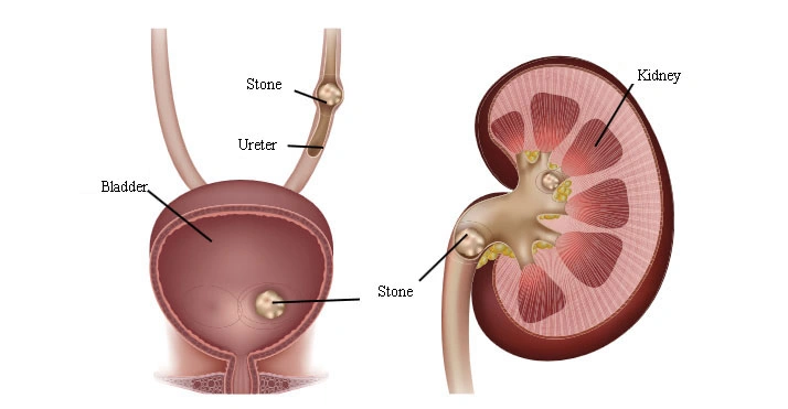 Renal Colic